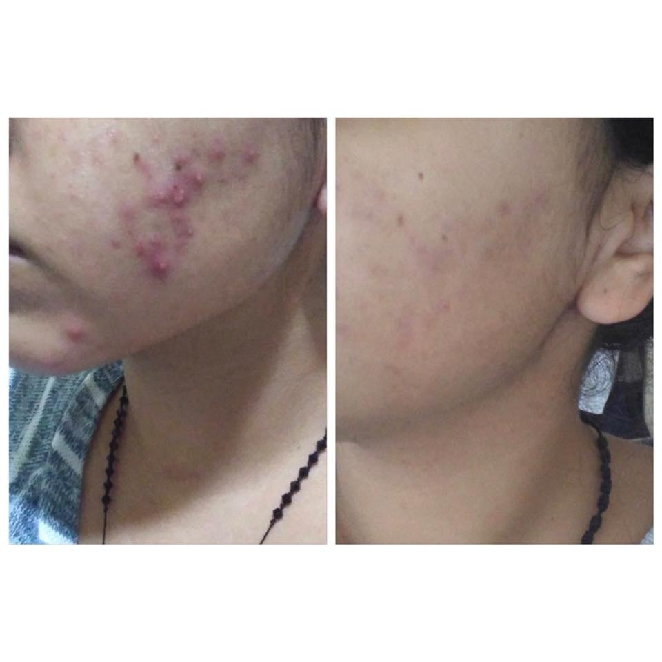 Before and after — Acne