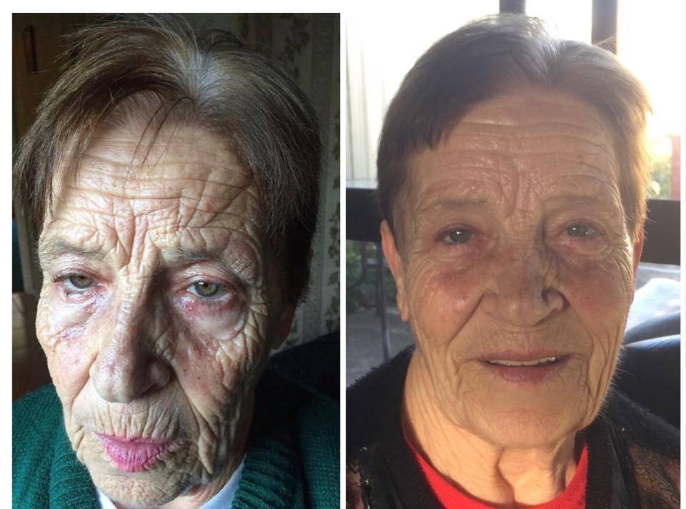 Before and after — Anti-ageing