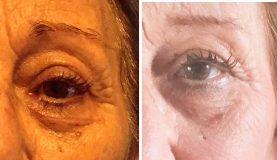 Before and after — Eye area