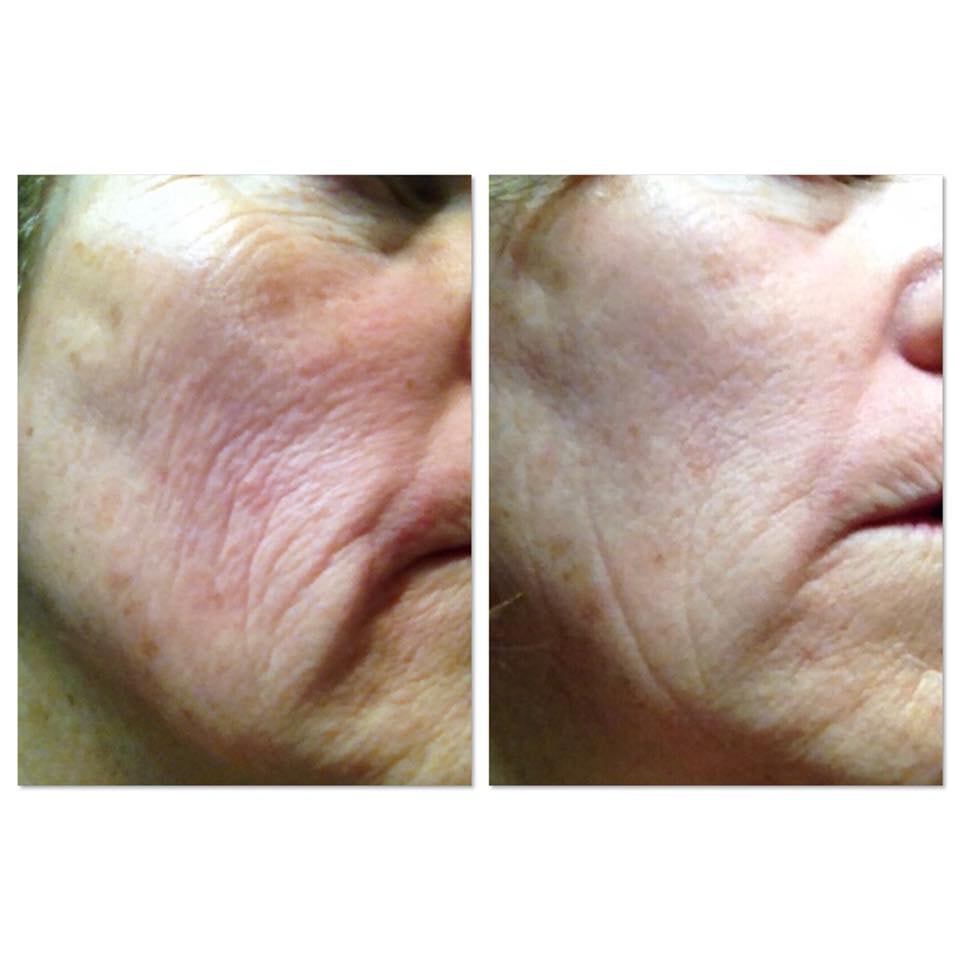 Before and after — Fine lines & wrinkles