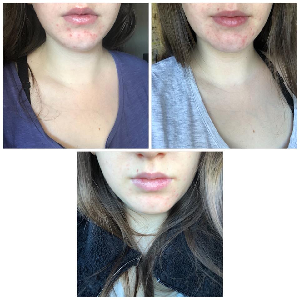 Before and after — Hormonal acne