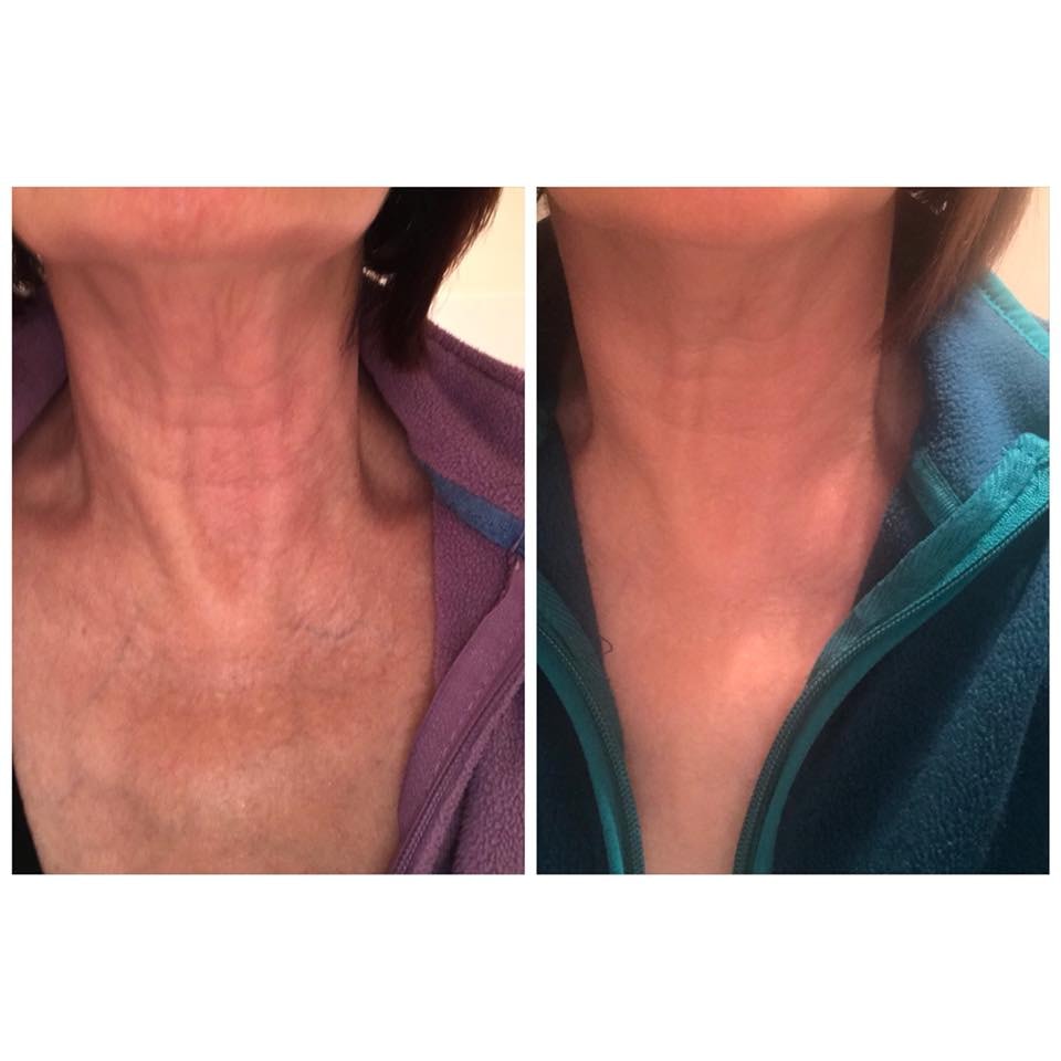 Before and after — Neck & décolletage