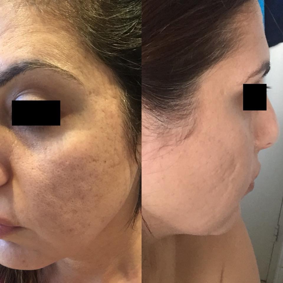 Before and after — Pigmentation
